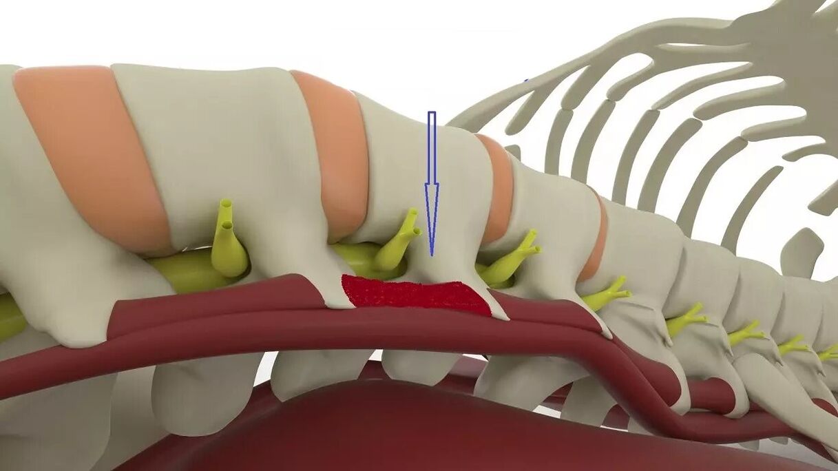 muskuļu spazmas ar jostas daļas osteohondrozi
