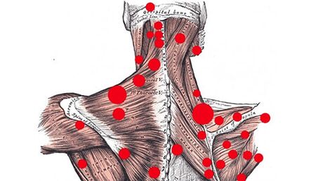 Palaišanas punkti muskuļos, kas izraisa miofasciālas muguras sāpes