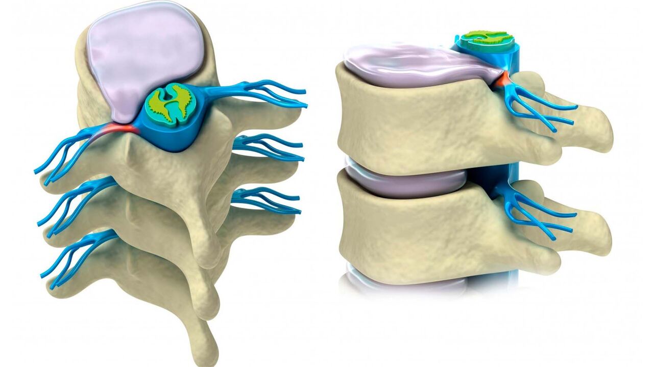 bojāts mugurkaula disks