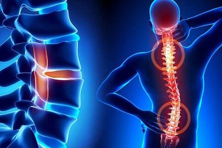 osteohondroze