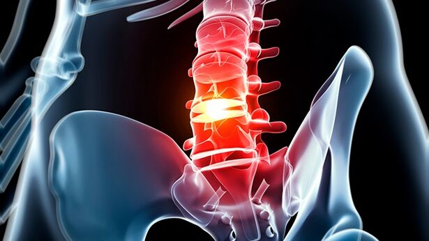 jostas mugurkaula osteohondroze