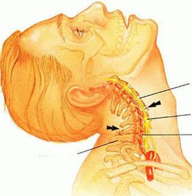 Dzemdes kakla mugurkaula osteohondroze